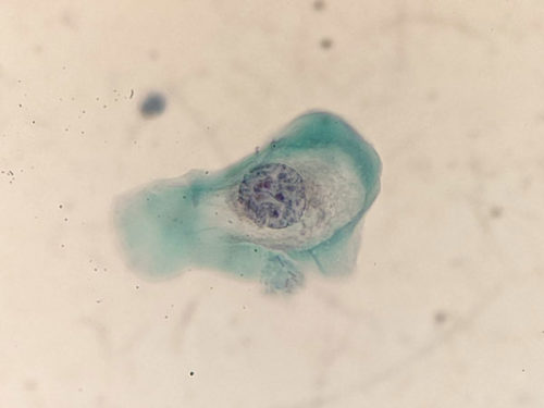 pap_hpv_citolab02 pap_hpv_citolab02